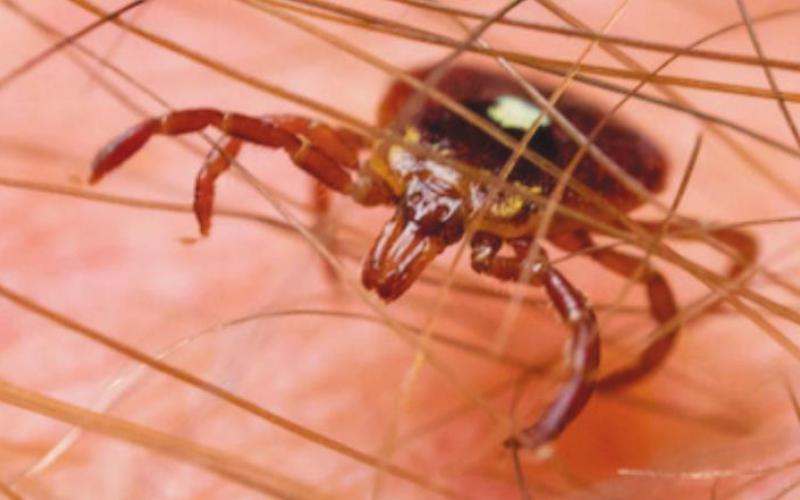 How to Treat a Tick Bite and When to See a Doctor